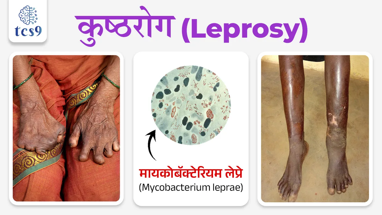 Which country was the first in the American continent to Eliminate leprosy?

Subject : GS - विज्ञान आणि तंत्रज्ञान - रोग आणि आजार

सरळसेवा, तलाठी, वनरक्षक, पोलीस भरती, अग्निवीर , रेल्वे भरती, SSC GD, MPSC, UPSC परीक्षेसाठी विचारलेले / संभाव्य महत्त्वपूर्ण  प्रश्न


प्रश्न) अलिकडे कोणता देश अमेरिकन खंडातील कुष्ठरोग (Leprosy) निर्मूलन करणारा पहिला देश ठरला आहे ?

1. चिली
2. ब्राझील
3. अर्जेंटिना
4. पेरू

उत्तर : चिली

📰 बातमी काय ?

• जागतिक आरोग्य संघटना (World Health Organization) आणि पॅन अमेरिकन हेल्थ ऑर्गनायझेशन (Pan American Health Organization) यांनी चिलीला कुष्ठरोग निर्मूलनासाठी प्रमाणित केले आहे.
• त्यामुळे चिली हा अमेरिकन खंडातील पहिला देश आणि जगातील दुसरा देश ठरला आहे.

(नोट : कुष्ठरोग दूर करणारा जगातील पहिला देश जॉर्डन आहे)

कुष्ठरोग कशामुळे होतो तो कसा पसरतो ?  
• कुष्ठरोग हा मायकोबॅक्टेरियम लेप्रे (Mycobacterium leprae)  या जिवाणूमुळे होतो.
• हा आजार मुख्यतः त्वचा, नस (nerves), डोळे आणि श्वसनमार्गावर परिणाम करतो.
• नाक आणि तोंडातून थेंबांद्वारे जिवाणू प्रसारित केले जातात.
• हस्तांदोलन करणे किंवा कुष्ठरोग झालेल्या व्यक्तीला मिठी मारणे, एकत्र जेवण करणे किंवा एकमेकांच्या शेजारी बसणे यासारख्या अनौपचारिक संपर्कातून हा रोग पसरत नाही.

कुष्ठरोगाचा शोध कोणी लावला ?
• इ.स. १८७३ मध्ये नॉर्वेतील वैद्य गेरहार्ट हेन्‍रिक आरमौअर हान्सेन (Gerhard Henrik Armauer Hansen) यांना प्रथम ऊतींच्या नमुन्यात कुष्ठरोगाचे जीवाणू आढळले. 
• या जीवाणूंमुळे कुष्ठरोग होतो, असे त्यांनी इ.स. १८७४ मध्ये सिद्ध केले.
• त्यांच्या या शोधामुळे कुष्ठरोगाला हान्सेन रोग (Hansen disease) असेही म्हणतात.


🌍 चिली देशाबद्दल थोडक्यात माहिती : 
• चिली हा दक्षिण अमेरिका खंडातील एक देश आहे.
•  तो अँडीज पर्वतरांग (Andes Mountains) आणि प्रशांत महासागर (Pacific Ocean) यांच्या दरम्यान लांब आणि अरुंद पट्ट्यासारखा पसरलेला आहे.
•  राजधानी → सॅंटियागो (Santiago)


🔑 परीक्षेच्या दृष्टीने IMP रिव्हिजन पॉईंट्स : कुष्ठरोग निर्मूलन

• कुष्ठरोग निर्मूलन करणारा → चिली (अमेरिकन खंडातील पहिला देश)
• जागतिक स्तर → चिली जगातील दुसरा देश 
• प्रमाणन → World Health Organization + Pan American Health Organization
• कुष्ठरोग कारणीभूत जीवाणू → मायकोबॅक्टेरियम लेप्रे
• कुष्ठरोगाचा शोध → गेरहार्ट हेन्‍रिक आरमौअर हान्सेन (1873)