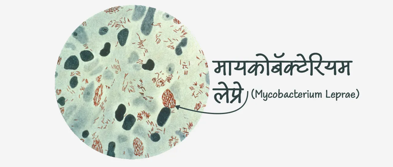 कुष्ठरोग कशामुळे होतो ?  
• कुष्ठरोग हा एक संसर्गजन्य रोग आहे.
• कुष्ठरोग हा मायकोबॅक्टेरियम लेप्रे या जिवाणूमुळे होतो.
• नाक आणि तोंडातून थेंबांद्वारे जिवाणू प्रसारित केले जातात.
• हस्तांदोलन करणे किंवा कुष्ठरोग झालेल्या व्यक्तीला मिठी मारणे, एकत्र जेवण करणे किंवा एकमेकांच्या शेजारी बसणे यासारख्या अनौपचारिक संपर्कातून हा रोग पसरत नाही.